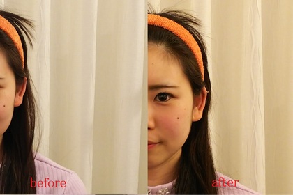 和田さん　小顔矯正施術前後比較(左半分)